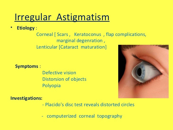 Irregular Astigmatism: Diagnosis and Treatment